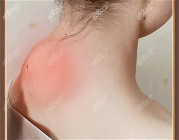 一针消除富贵包的方式和其他方式有啥区别？