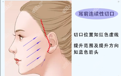 北京黄寺整形医院杜太超小拉皮提升