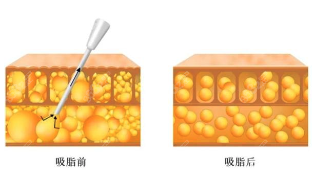 吸脂比较好的医院到底有哪些