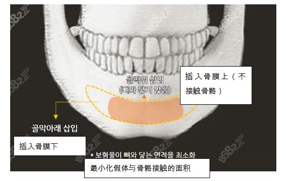 韩国ts整形李相均院长做尖下巴手术特色