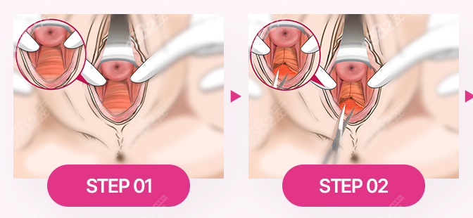韩国私密整形手术过程图1-2