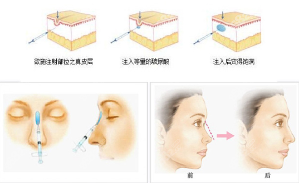 润百颜玻尿酸怎么样