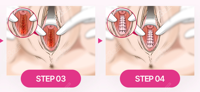 韩国私密整形手术过程图3-4