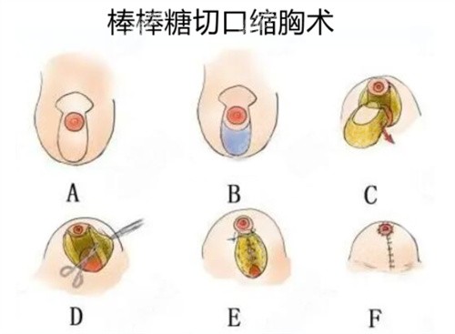 成都画美赵敬国医生做乳房缩小价格多少钱？