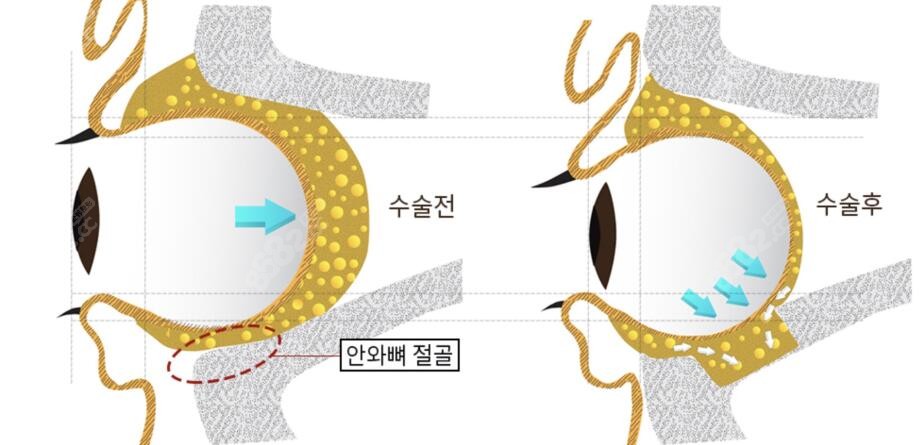 突眼矫正手术方式