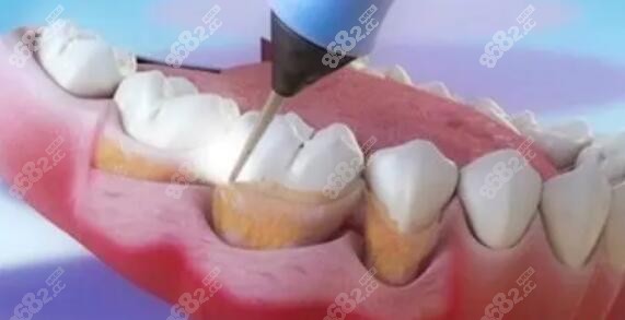 洗牙后导致牙龈萎缩多久能恢复