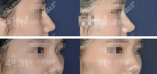 韩国431整形金载勋驼峰鼻矫正术前术后对比