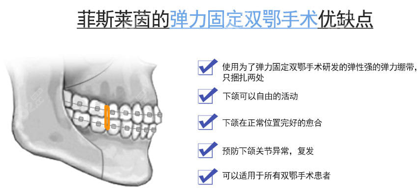 菲斯莱茵SMART双颚术优势