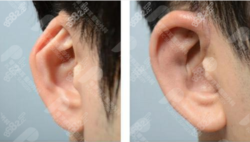 韩国普罗菲耳整形隐耳矫正实例（m.8682.cc）