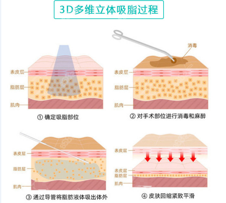 万州华美紫馨面部抽脂靠谱m.8682.cc