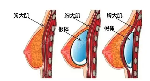 男士是可以做假体隆胸手术