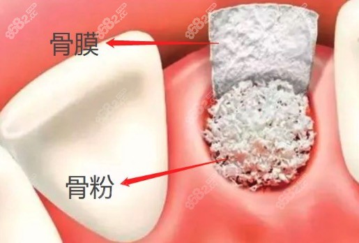 种植牙骨膜骨粉示意图
