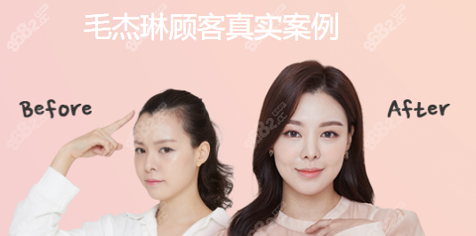 韩国毛杰琳植发前后对比图女性