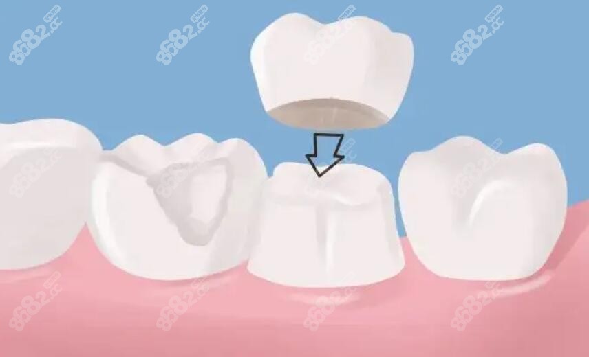 根管治疗后戴牙冠