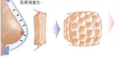 韩国安敬天吸脂丰胸怎么样