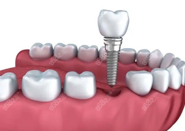 数字化即刻种植牙齿好吗？数字化种牙和传统种植牙区别在哪