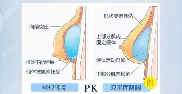 上海伯思立做假体隆胸优势