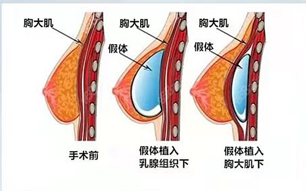 上海伯思立隆胸技术 8682.cc