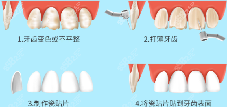 牙贴面操作过程图解