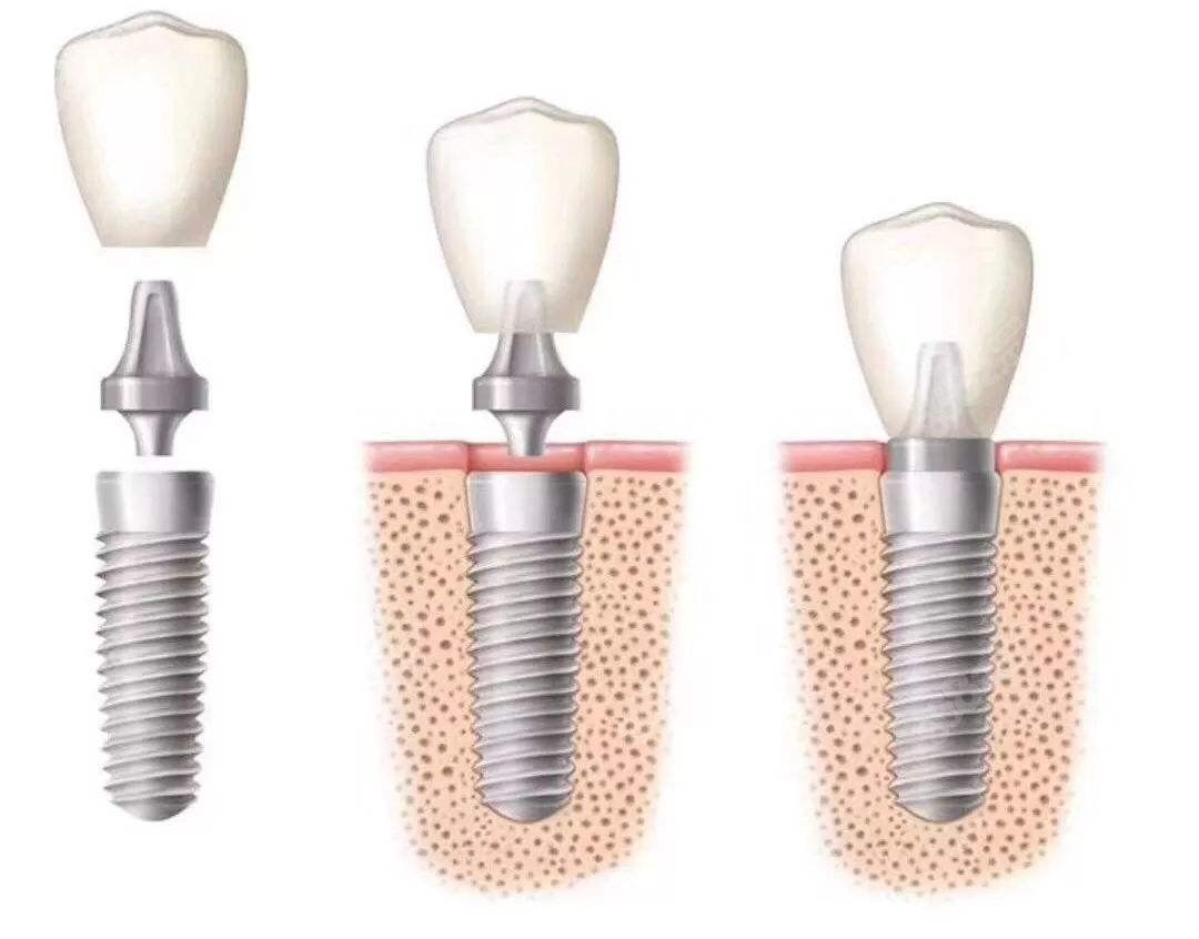 辨别真正的3D数字化舒适种植 实现好牙好身体——广州德伦口腔