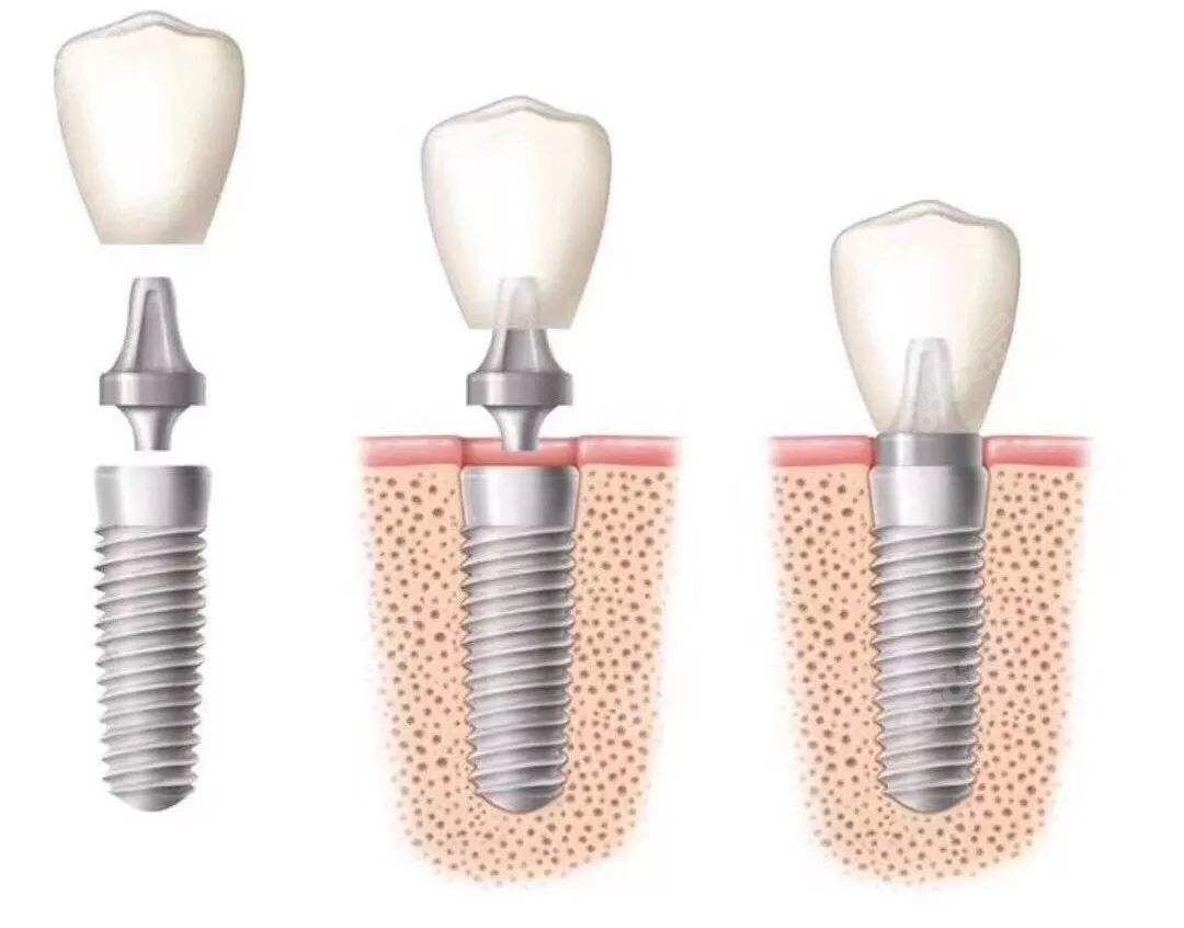 种植牙的基台图片,种植牙图片,种植牙图片价格,种植牙过程图片_第三时空网