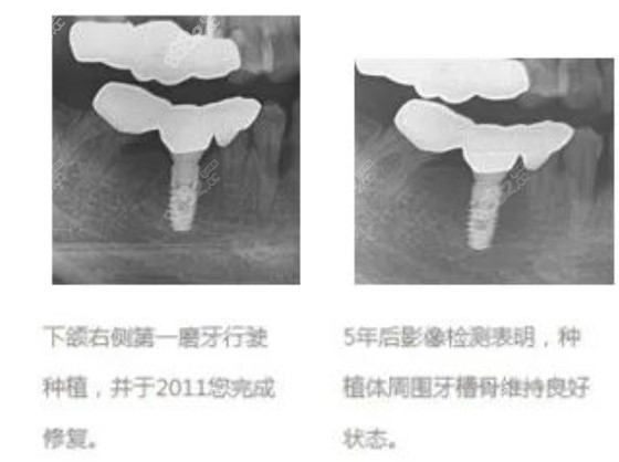 经S.L.A表面处理的仕诺康种植体的5年影像报告