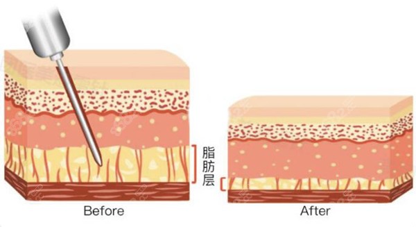 南通吸脂医生片面推荐