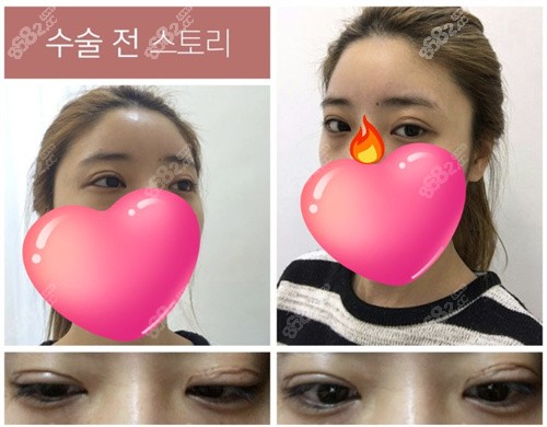 韩国必当归医院双眼皮修复前照片