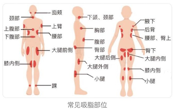 南通吸脂哪个医生好?www.8682.cc