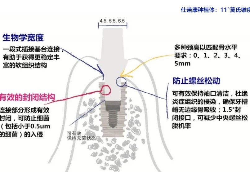 仕诺康种植体设计优势