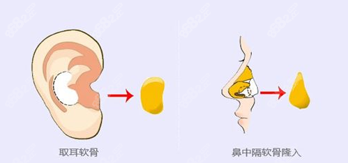 南阳做自体软骨隆鼻过程www.8682.cc