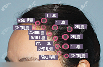 宜宾韩美种植发际线布局示意图