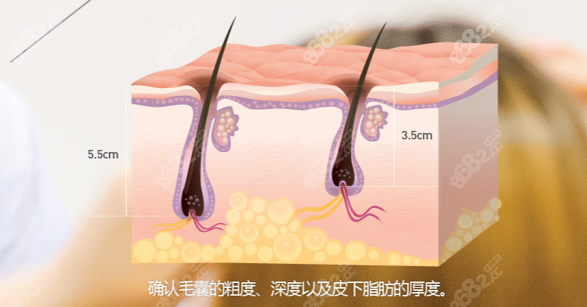 宜宾天使之翼植发成活率较高8682.cc