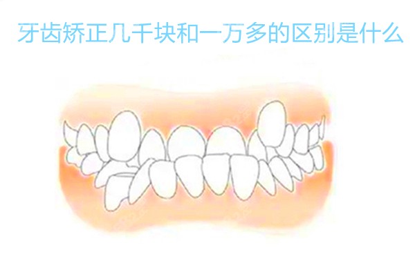 牙齿矫正几千块和一万多的区别是什么