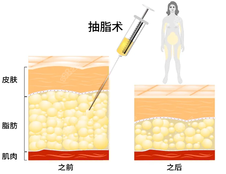 濮阳做抽脂手术对比www.8682.cc