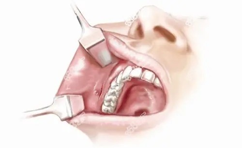 磨骨手术可能会出现后遗症8682.cc