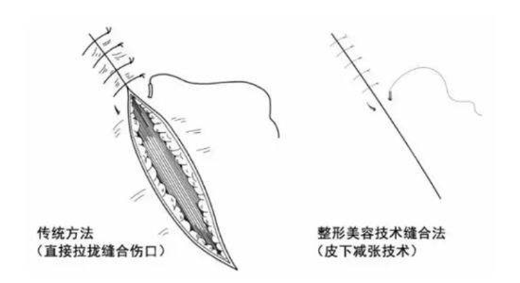 安可忍做腹壁整形用内窥镜辅助切口小不用担心疤痕增生问题