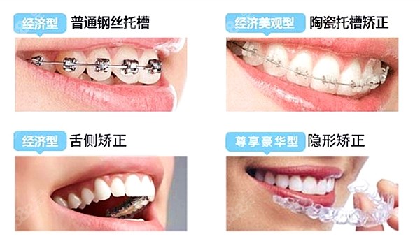 矫正牙齿一般分为几个阶段