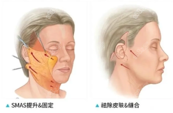 小拉皮手术过程图示