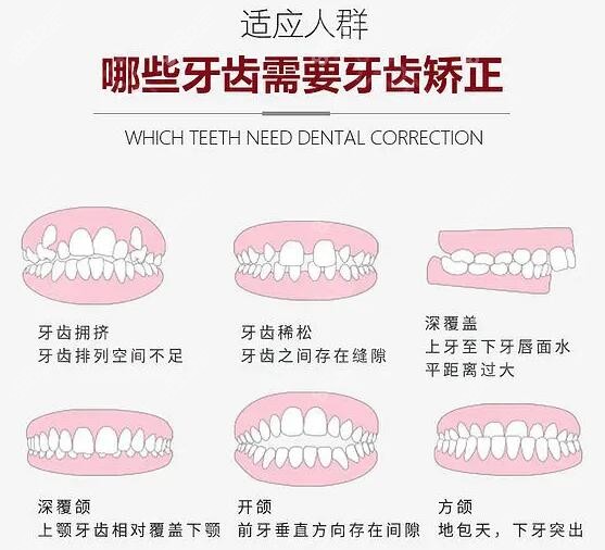 深圳南山区牙齿矫正价格多少钱?隐形矫正1-4万(2023收费标准)