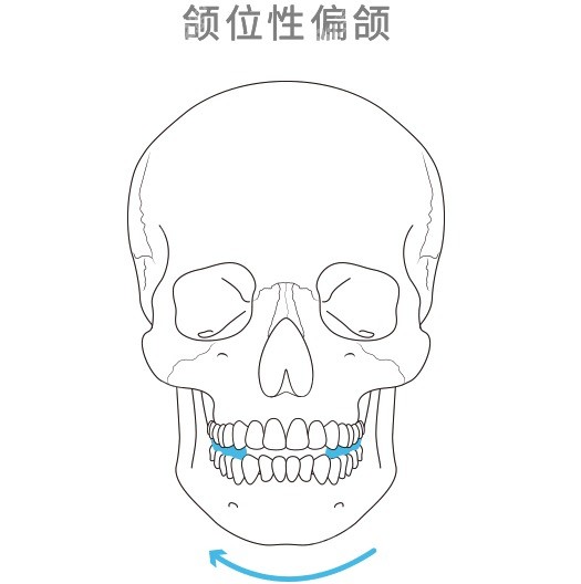 正雅S10是上颌后牙解剖式𬌗垫的隐形化