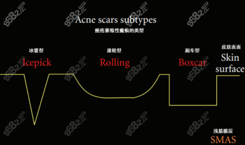 痘印痘坑的类型m.8682.cc