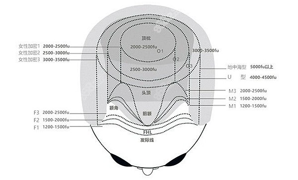 韩国做毛发移植价格表 8682.cc