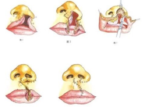 余文林唇裂修复手术方式