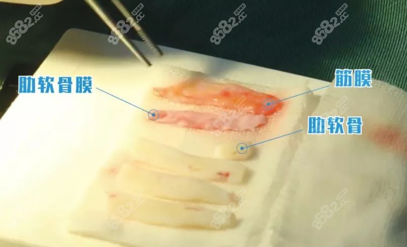 朴哲佑隆鼻技术好