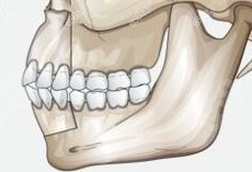 骨性凸嘴正颌手术后脸型改变图