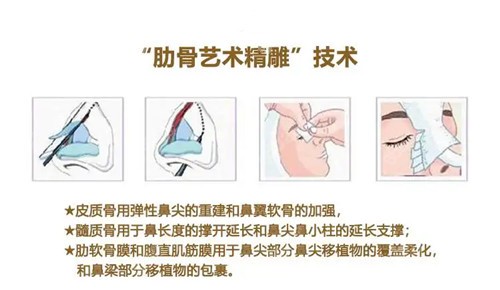 隆鼻技术特点