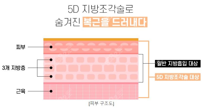 安敬天医生做5d吸脂手术改善的皮肤组织