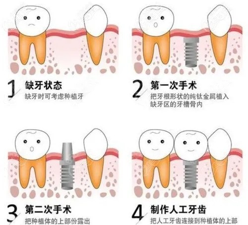 纽百特种植体