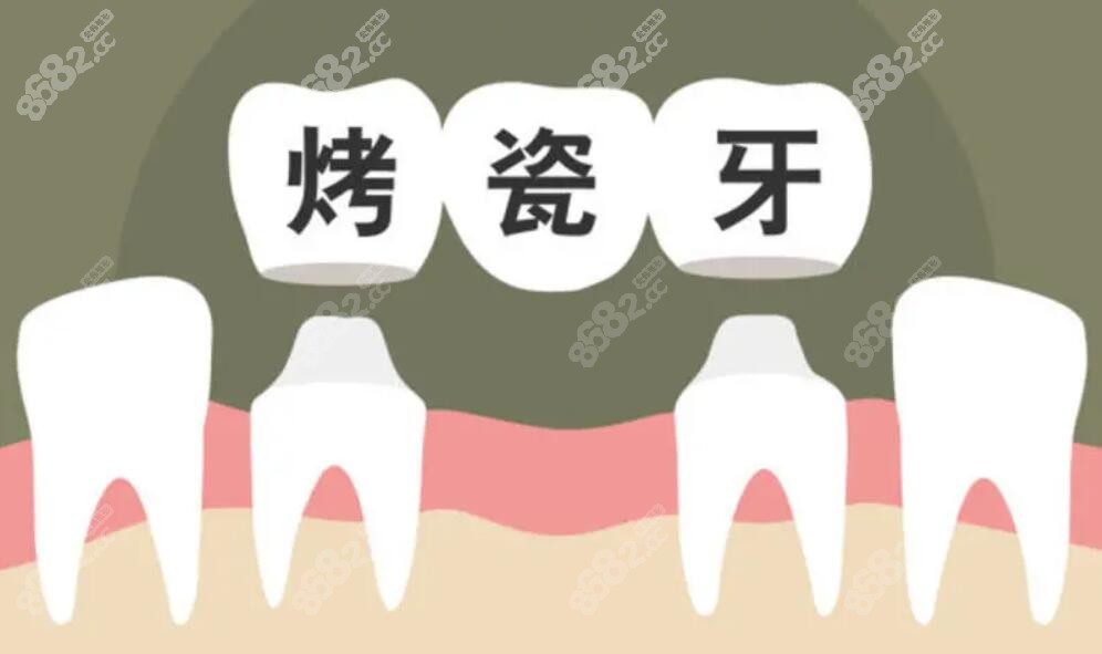 三颗连桥烤瓷牙